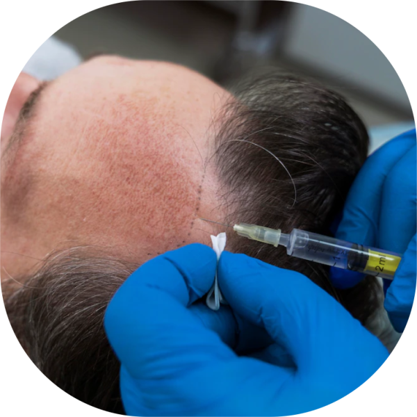 Hair Transplant